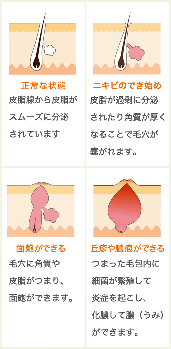 ニキビ 症状別漢方体質改善プログラム 漢方 漢方薬の薬日本堂